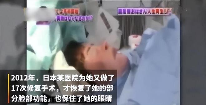 整容上瘾自行注射大豆油最终把脸整成电风扇AG真人百家家乐app颜值不输张曼玉却(图1)