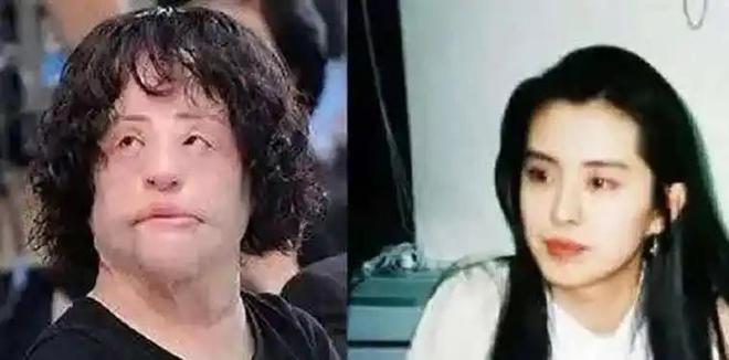 整容上瘾自行注射大豆油最终把脸整成电风扇AG真人百家家乐app颜值不输张曼玉却(图5)