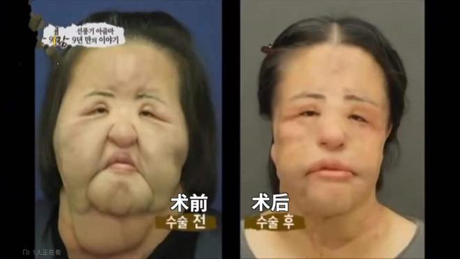 整容上瘾自行注射大豆油最终把脸整成电风扇AG真人百家家乐app颜值不输张曼玉却(图13)